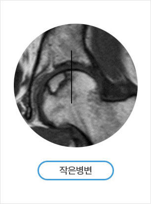 괴사부위 크기 분류 방법