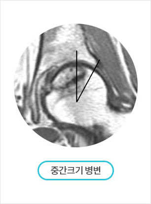괴사부위 크기 분류 방법