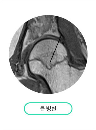 괴사부위 크기 분류 방법