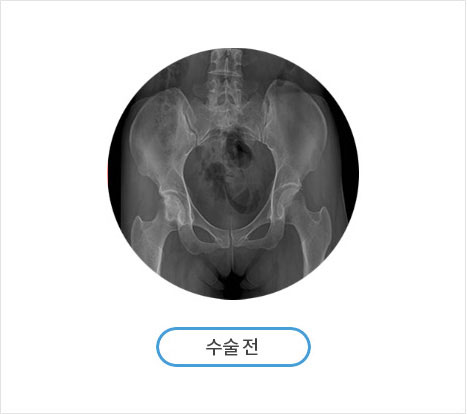 절골술