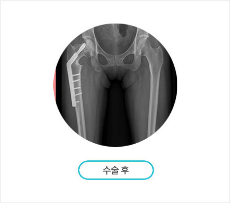 절골술
